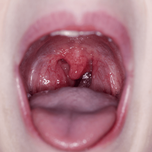 urgent care for strep throat