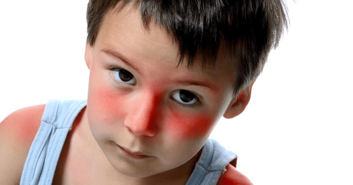 sunburn in children