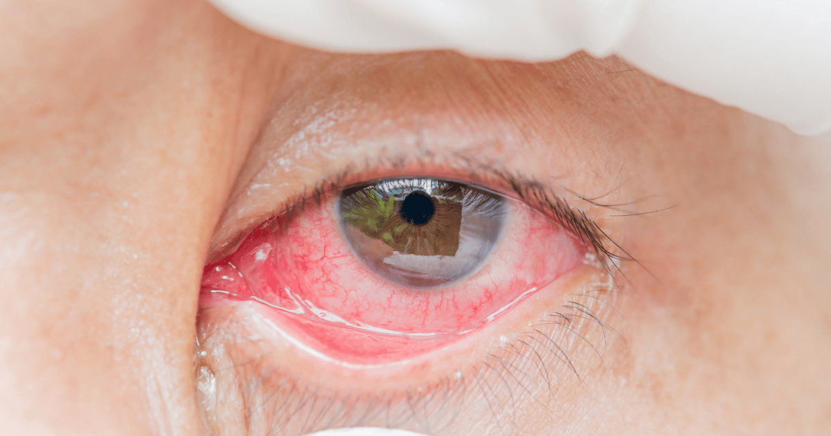 symptoms of pink eye