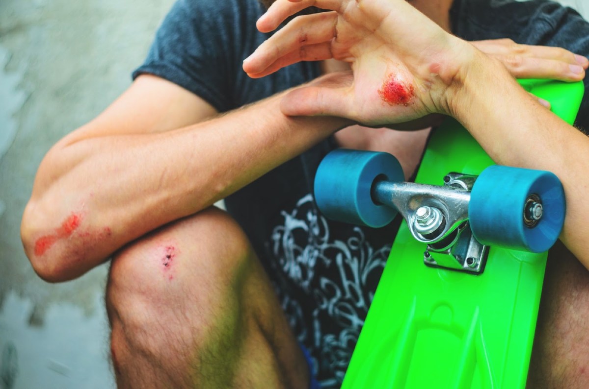 skateboarder with minor wounds
